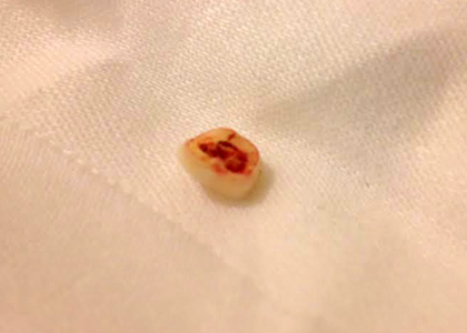 tooth